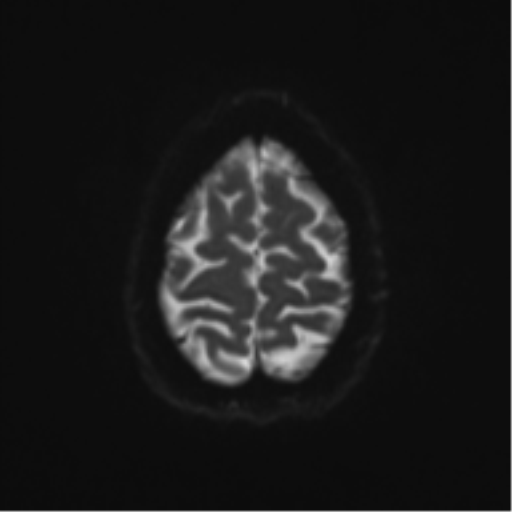 File:Cerebral cavernoma and development venous anomaly (Radiopaedia 37603-39482 Axial DWI 20).png