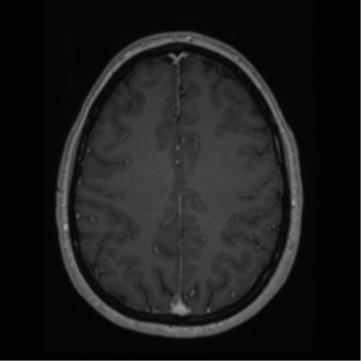 File:Cerebral cavernoma and development venous anomaly (Radiopaedia 37603-39482 Axial T1 C+ 53).png