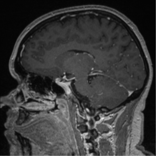 Cerebral cavernoma and development venous anomaly (Radiopaedia 37603-39482 Sagittal T1 C+ 55).png