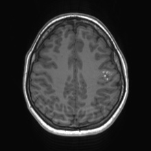 Cerebral cavernous venous malformation (Radiopaedia 70008-80021 Axial T1 58).jpg
