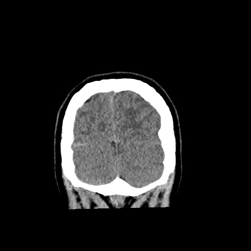 Cerebral cavernous venous malformation (Radiopaedia 70008-80022 non-contrast 63).jpg