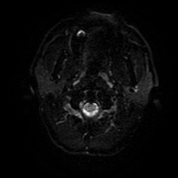 Cerebral cavernous venous malformation (Zabramski type II) (Radiopaedia 85511-101198 Axial DWI 67).jpg