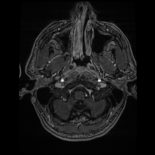 Cerebral cavernous venous malformation (Zabramski type II) (Radiopaedia 85511-101198 Axial T1 C+ fat sat 75).jpg