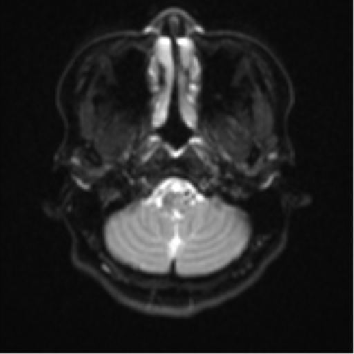 Cerebral cavernous venous malformations (Radiopaedia 48117-52946 Axial DWI 3).png