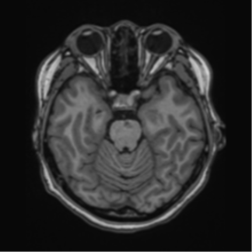 File:Cerebral cavernous venous malformations (Radiopaedia 48117-52946 Axial T1 7).png