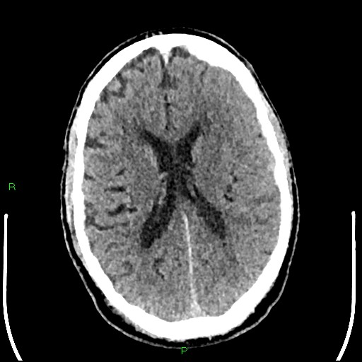 Cerebral contusions (Radiopaedia 33868-35039 Axial non-contrast 126).jpg