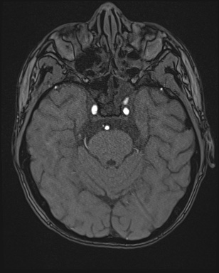 Cerebral embolic infarcts (embolic shower) (Radiopaedia 72391-82921 Axial MRA 43).jpg