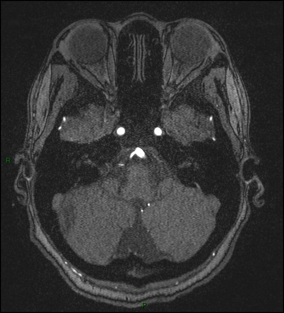 Cerebral fat embolism (Radiopaedia 35022-36525 Axial TOF 40).jpg