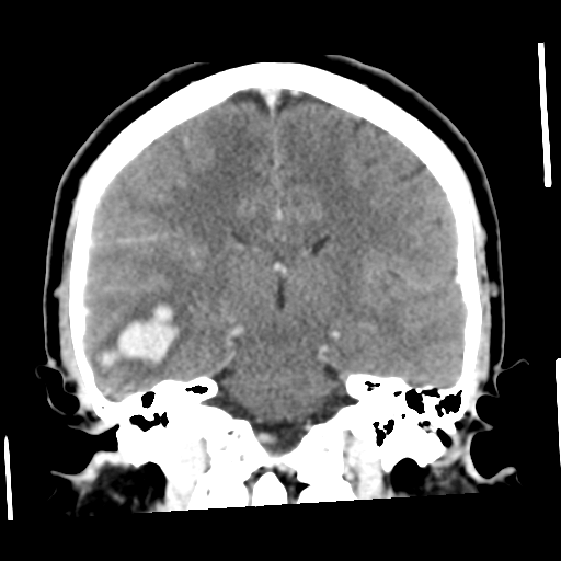 Cerebral hemorrhage secondary to arteriovenous malformation (Radiopaedia 33497-34561 C 38).png