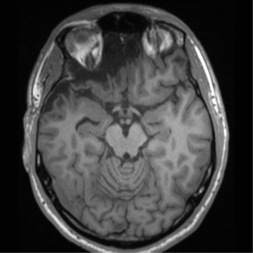 Cerebral hemorrhagic contusions- temporal evolution (Radiopaedia 40224-42757 Axial T1 30).png