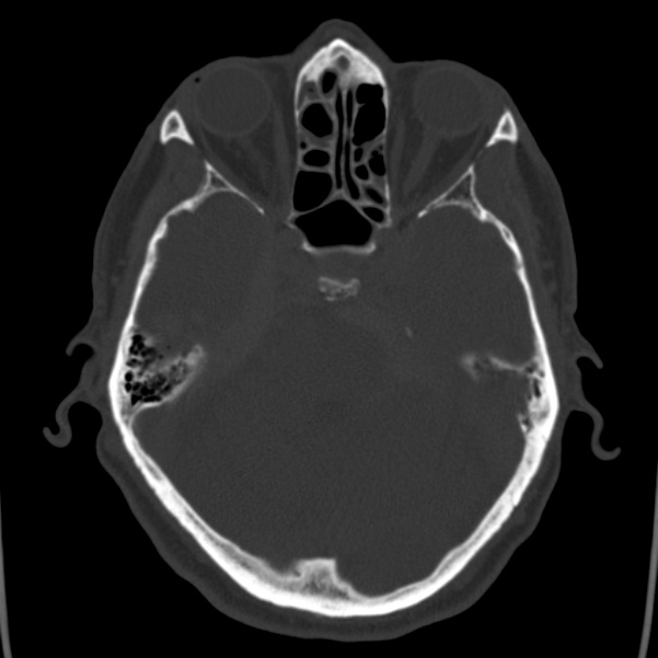 Cerebral hemorrhagic contusions (Radiopaedia 23145-23188 Axial bone window 17).jpg