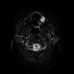 Cerebral metastases - melanoma (Radiopaedia 80972-94522 Axial DWI 66).jpg