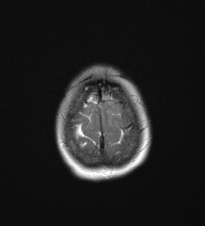 File:Cerebral metastasis (Radiopaedia 46744-51248 Axial T2 26).png
