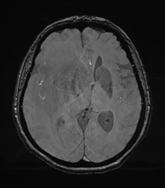 Cerebral metastasis to basal ganglia (Radiopaedia 81568-95413 Axial SWI magnitude 43).png