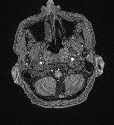 File:Cerebral toxoplasmosis (Radiopaedia 43956-47461 Axial T1 5).jpg