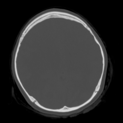 File:Cerebral tuberculosis with dural sinus invasion (Radiopaedia 60353-68018 Axial bone window 36).jpg
