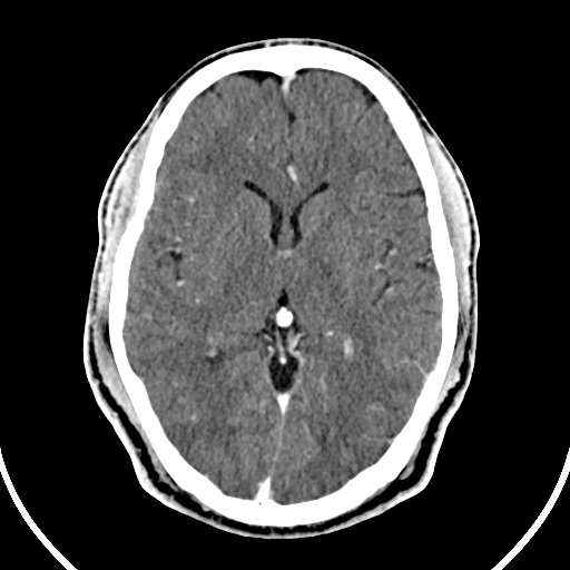 Cerebral venous angioma (Radiopaedia 69959-79977 B 45).jpg