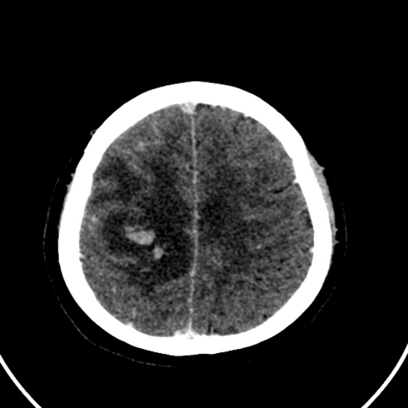 File:Cerebral venous hemorrhagic infarct from venous sinus thrombosis (Radiopaedia 55433-61883 Axial C+ delayed 38).jpg