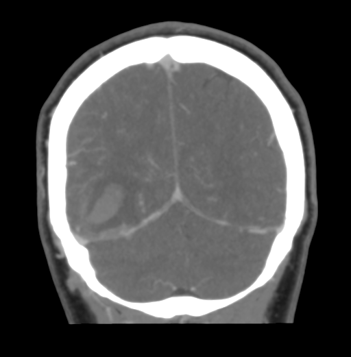 Cerebral venous hemorrhagic infarction (Radiopaedia 38461-40550 Coronal MIP VENOGRAM 47).png