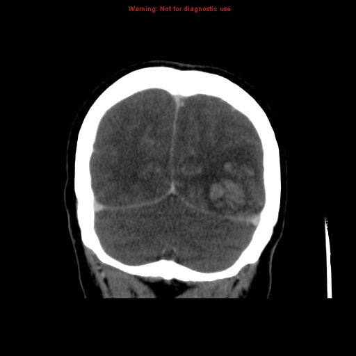 Cerebral venous infarction (Radiopaedia 12404-20735 B 68).jpg