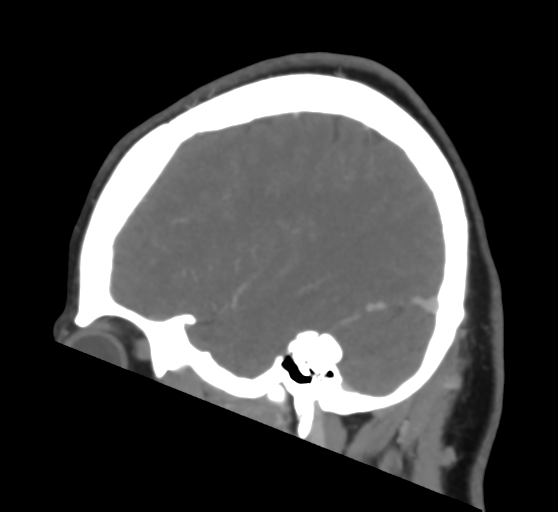 File:Cerebral venous infarction due to transverse sinus thrombosis (Radiopaedia 34688-36120 Sagittal CT venogram 40).png