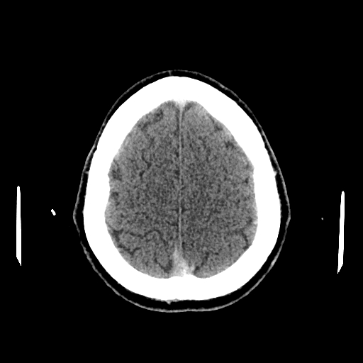 File:Cerebral venous thrombosis (CVT) (Radiopaedia 77524-89685 Axial non-contrast 40).jpg