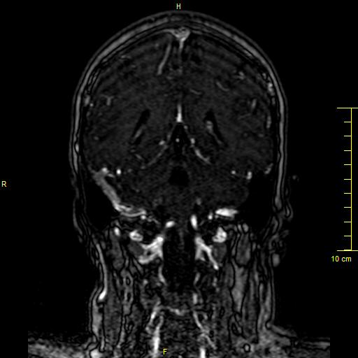 Cerebral venous thrombosis (Radiopaedia 23288-23351 MRV 109).JPG