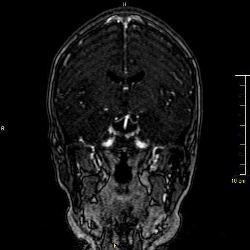 Cerebral venous thrombosis (Radiopaedia 23288-23351 MRV 70).JPG