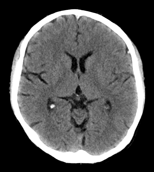 File:Cerebral venous thrombosis (Radiopaedia 38392-40467 Axial non-contrast 14).png
