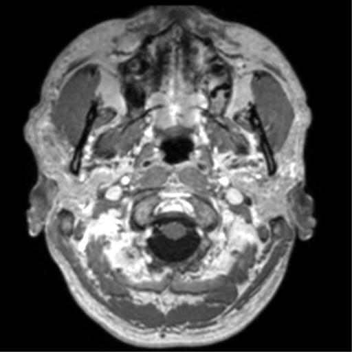 Cerebral venous thrombosis (Radiopaedia 38392-40469 Axial T1 C+ 7).png