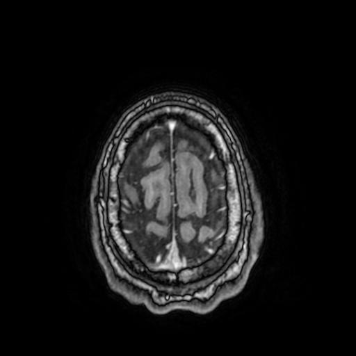 File:Cerebral venous thrombosis with secondary intracranial hypertension (Radiopaedia 89842-106957 Axial T1 C+ 151).jpg