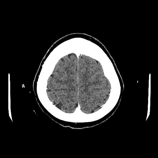 Cerebral venous thrombosis with venous hemorrhagic infarct (Radiopaedia 90354-107660 Axial with contrast 142).jpg