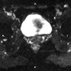 File:Cervical adenocarcinoma (Radiopaedia 65011-73985 Axial DWI 34).jpg