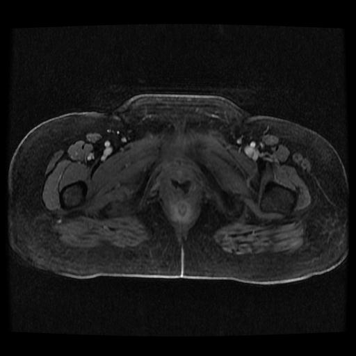 File:Cervical carcinoma (Radiopaedia 70924-81132 Axial T1 C+ fat sat 198).jpg