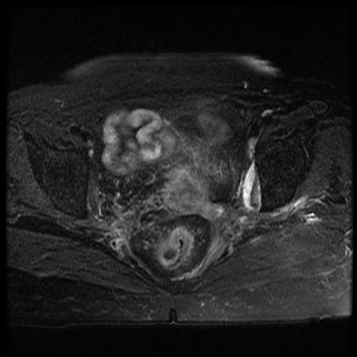 File:Cervical carcinoma (Radiopaedia 70924-81132 Axial T2 fat sat 8).jpg