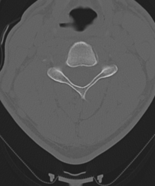Cervical intercalary bone (Radiopaedia 35211-36748 Axial bone window 33).png