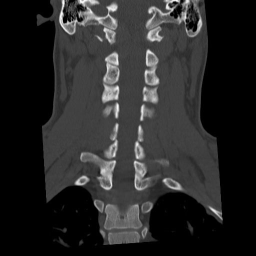 Cervical schwannoma (Radiopaedia 57979-64974 Coronal bone window 34).png