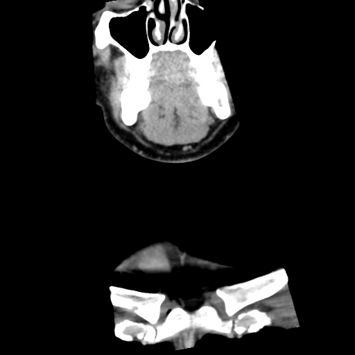 Cervical schwannoma (Radiopaedia 57979-64974 G 11).png