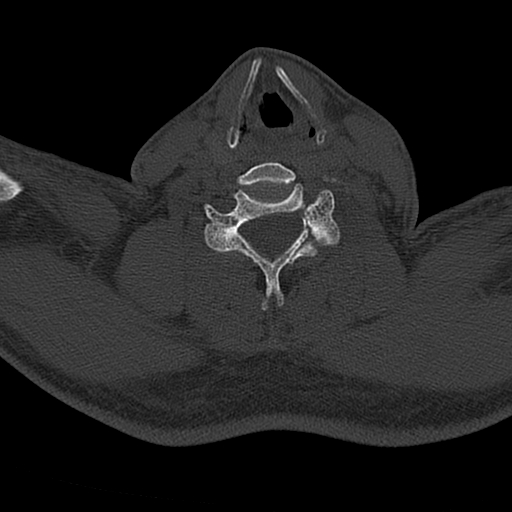 Cervical spine trauma with tear drop fracture and perched facet joint (Radiopaedia 53989-60127 Axial bone window 122).jpg