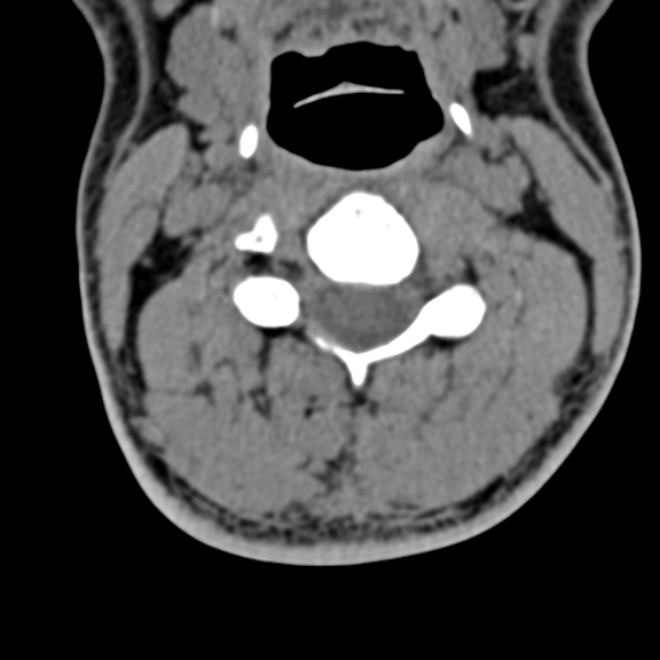 Cervical spondylodiscitis (Radiopaedia 28057-29489 Axial non-contrast 35).jpg