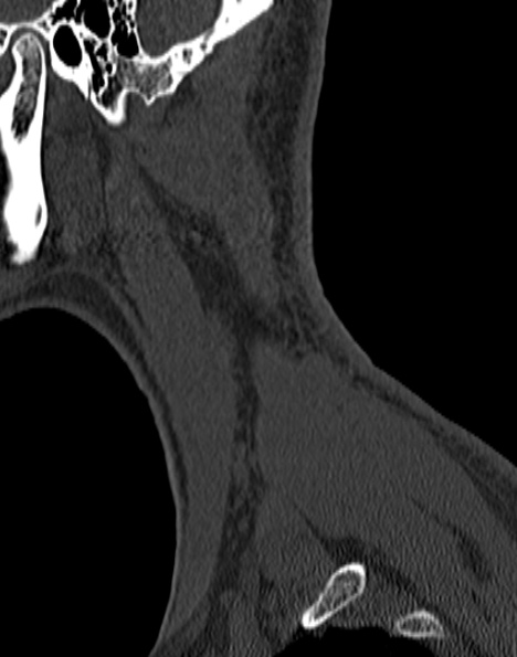 Cervical spondylodiscitis (Radiopaedia 28057-29489 Sagittal bone window 60).jpg