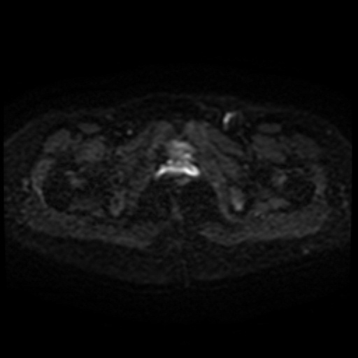 Cesarian section scar endometriosis (Radiopaedia 66520-75799 Axial DWI 47).jpg