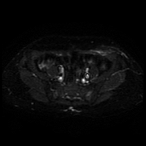 Cesarian section scar endometriosis (Radiopaedia 66520-75799 Axial DWI 5).jpg