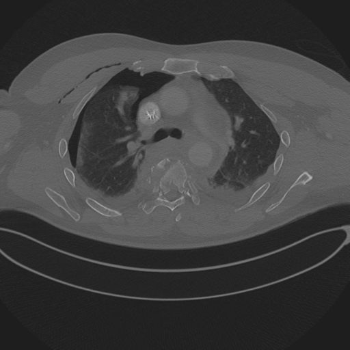 File:Chest multitrauma - aortic injury (Radiopaedia 34708-36147 Axial bone window 112).png