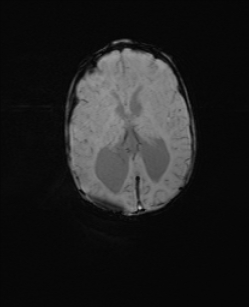 Chiari III malformation with occipital encephalocele (Radiopaedia 79446-92559 Axial SWI 39).jpg
