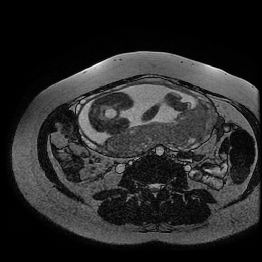 Chiari II malformation - fetal MRI (Radiopaedia 68099-77581 Axial Fiesta 6).jpg