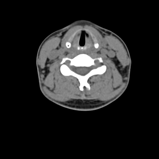 Chiari I malformation and obstructive hydrocephalus (Radiopaedia 41185-43981 D 59).png