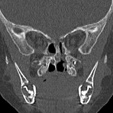 Choanal atresia (Radiopaedia 88525-105975 Coronal bone window 67).jpg