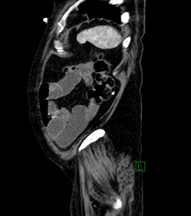 Cholangiocarcinoma with cerebral metastases (Radiopaedia 83519-98629 F 19).jpg