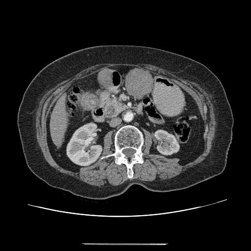 Cholecystoduodenal fistula (Radiopaedia 35234-36772 A 73).jpg